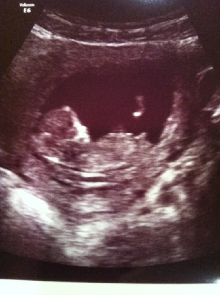 12 week ultrasound pic- gender guess? - BabyCenter